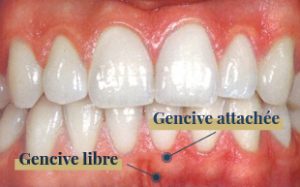 gencive libre et attachée