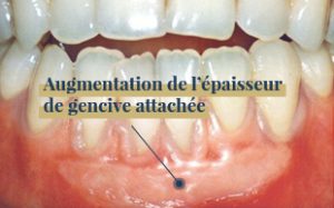 augmentation épaisseur gencive attachée