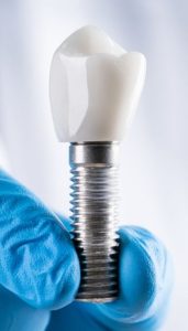 implant-dentaire-clinique-dentaire-bastien-dussault-a-laval