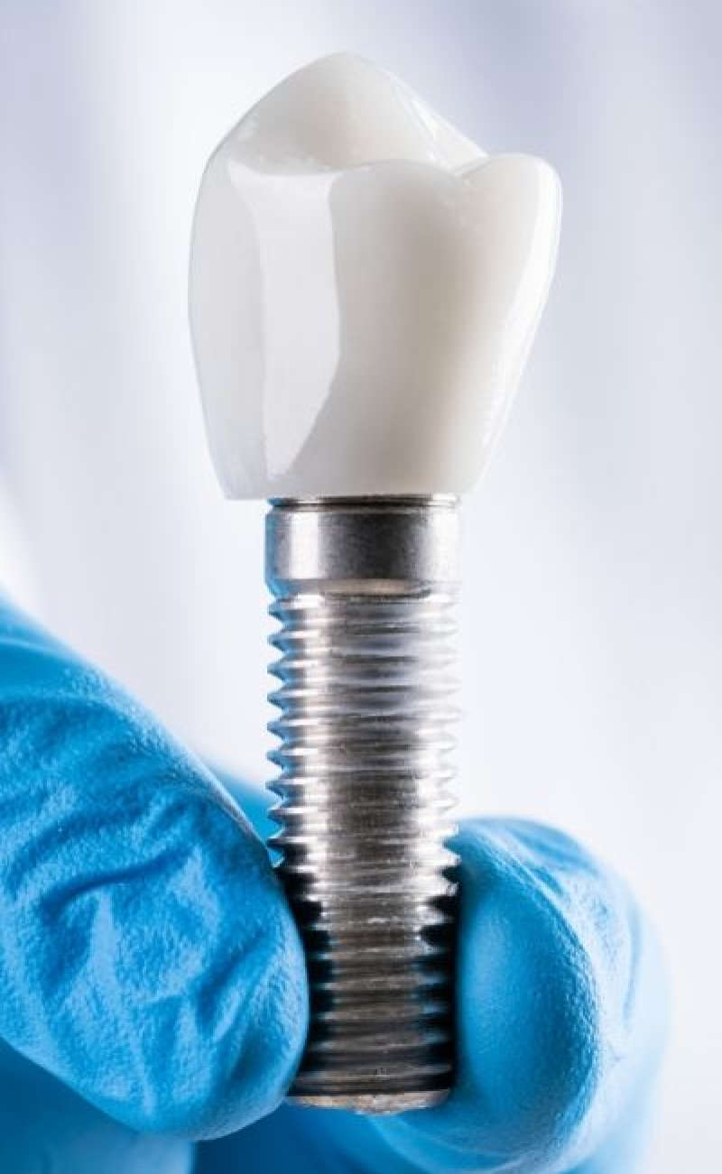 implant-dentaire-clinique-dentaire-bastien-dussault-a-laval